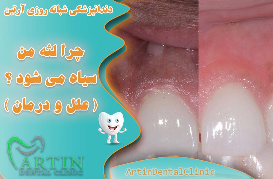 چرا لثه من سیاه می شود ؟ ( علل و درمان )