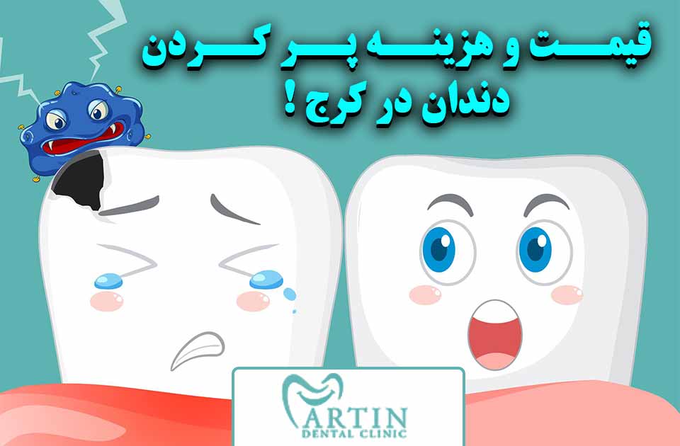 قیمت و هزینه پرکردن دندان در کرج !