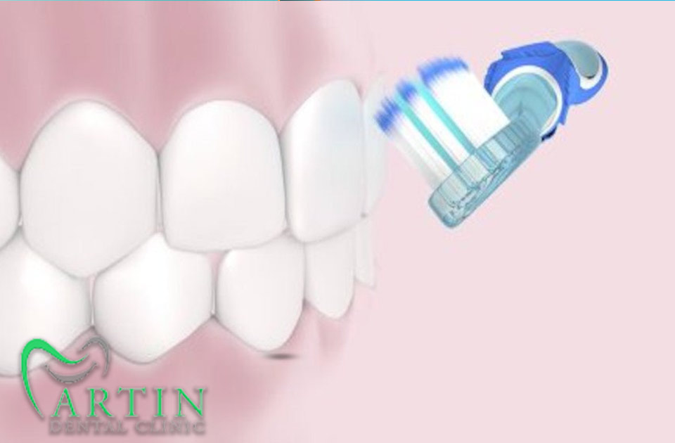 بروساژ دندان 