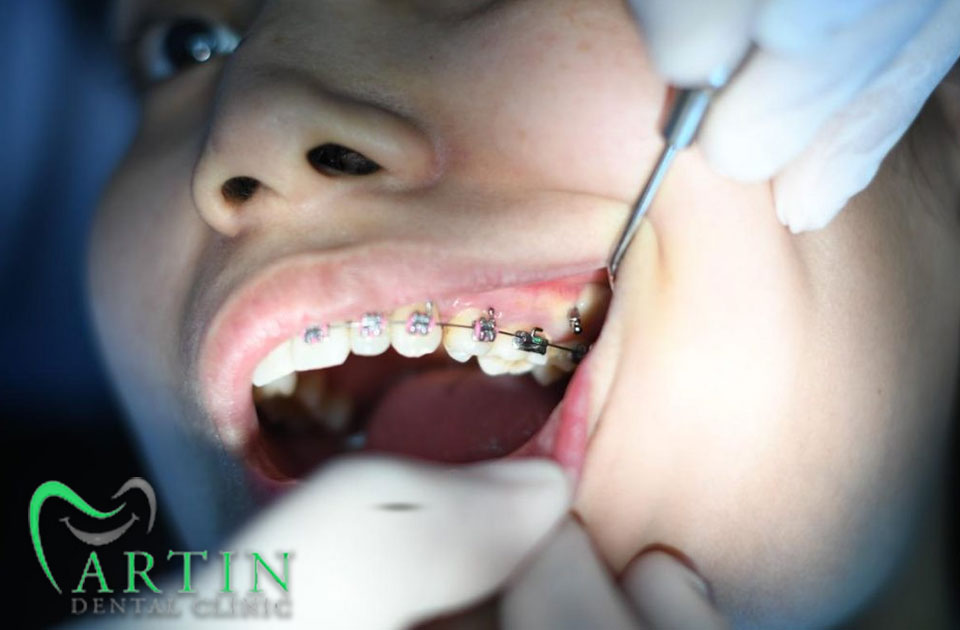 مزایای کشیدن دندان عقل پیش از ارتودنسی