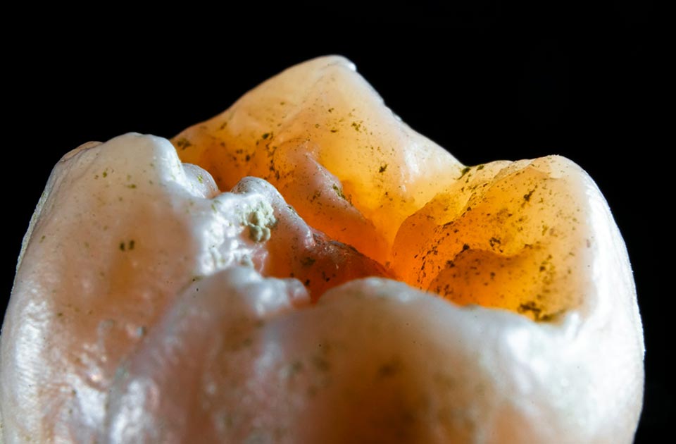 از بین رفتن مینای دندان 