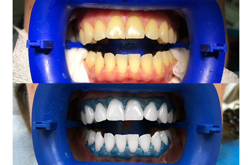 سفید کردن دندان فوری در خانه