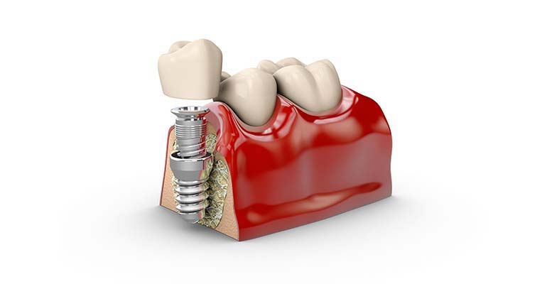 ایمپلنت دندان چیست ؟