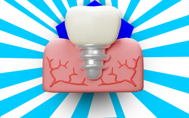 ایمپلنت دندان در کرج