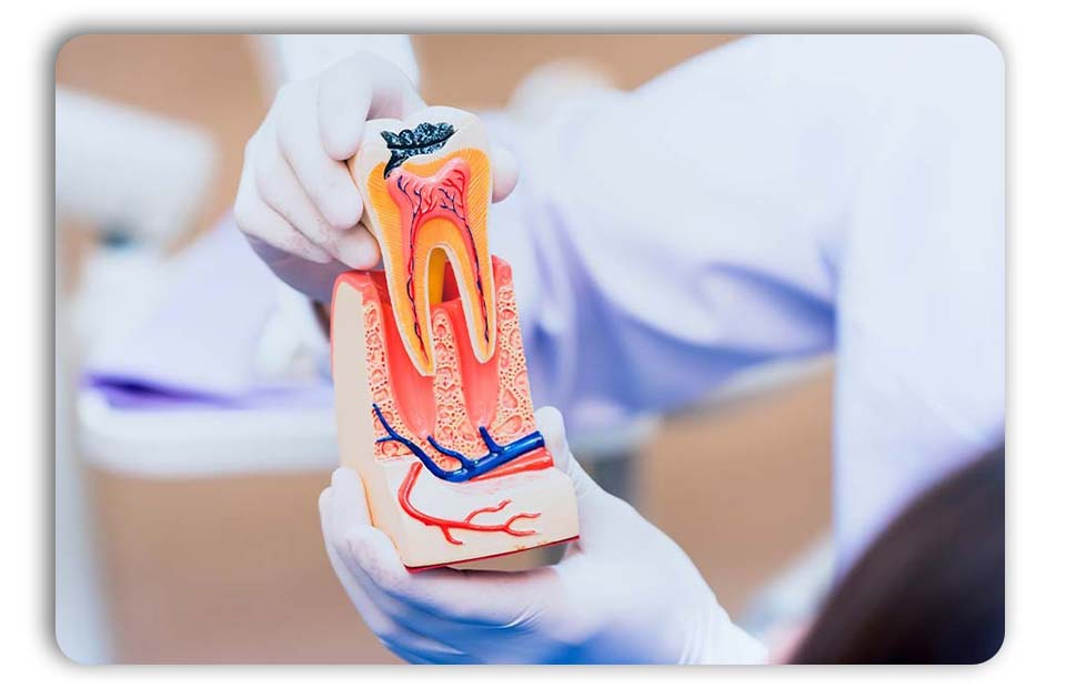 درمان ریشه دندان